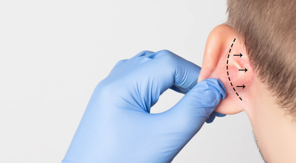 Korekcja uszu to zabieg chirurgiczny, który pozwala poprawić kształt, proporcje i symetrię małżowin usznych. Fachowo określany jako otoplastyka, jest bezpiecznym i skutecznym rozwiązaniem zarówno dla dzieci (od 7. roku życia), jak i dorosłych....